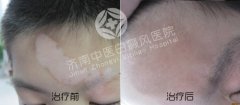 儿童患上白癜风有哪些症状