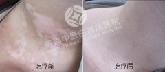 患上白癜风的症状有哪些