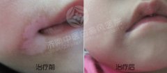 头部白癜风患者的注意事项有什么