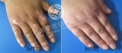 白癜风小面积早期该怎么去治疗